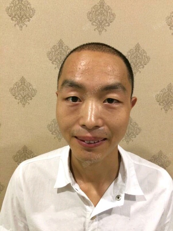 氧气xhhlk种植发际线第14天美丽日记-新氧美容