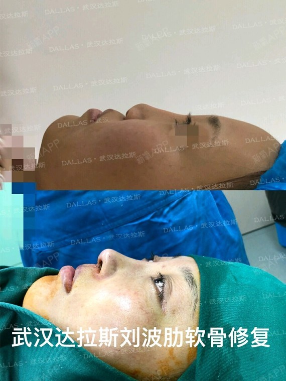 【肋软骨做了隆鼻以后能维持多长时间?】有的