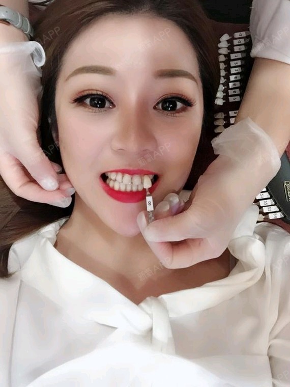 广州冷光美白好不好_效果图_ashou庆冷光美白术后第0