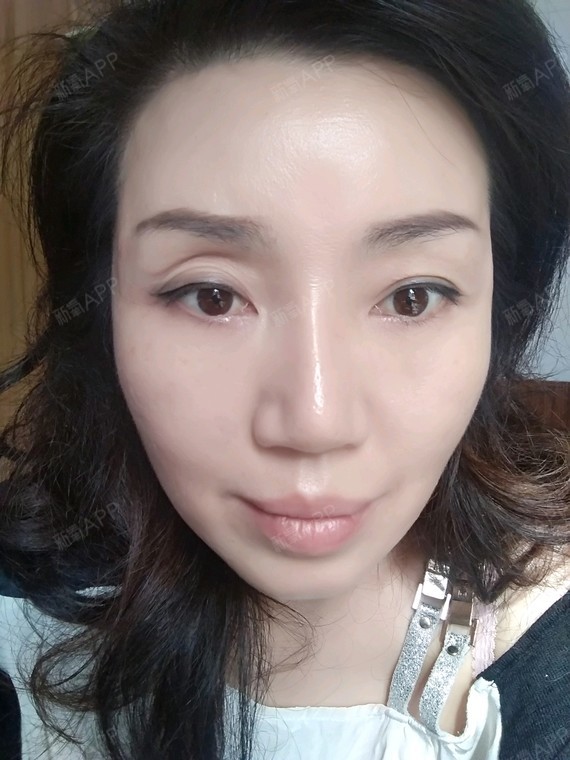 自体脂肪丰眼窝