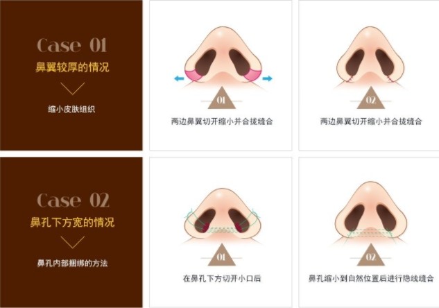 标准美鼻的鼻翼是有一定标准的,鼻的宽度是指两侧鼻翼