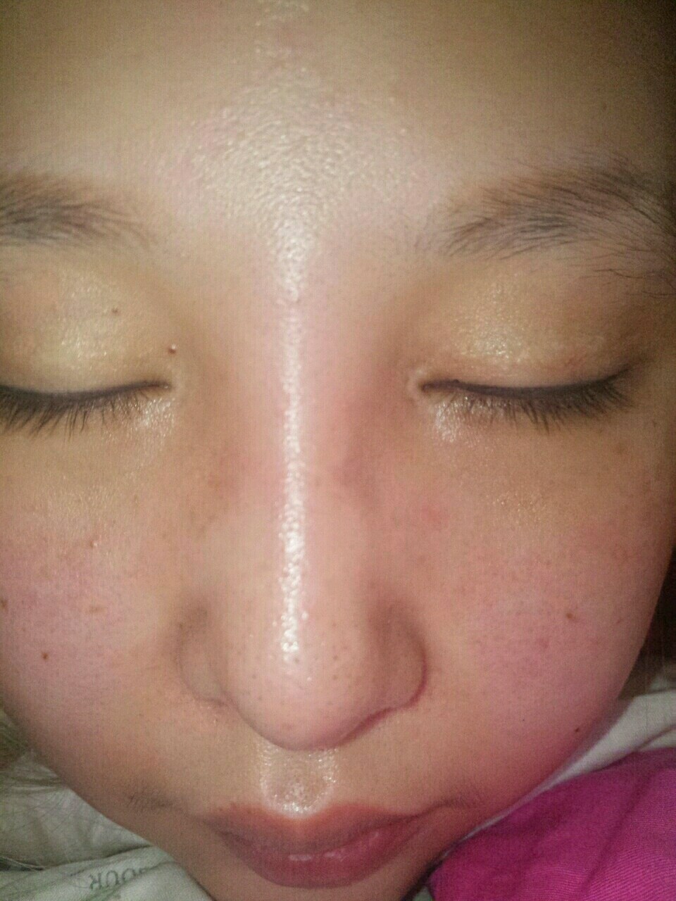 我做的韩式生科柳叶型硅胶假体 双侧耳软骨 鼻中隔软骨 鼻综合,全麻