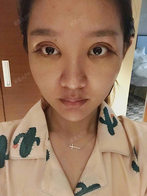 萌萌哒哒萌萌哒眼部综合第0天美丽日记-新氧美