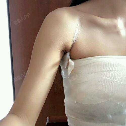 假体隆胸