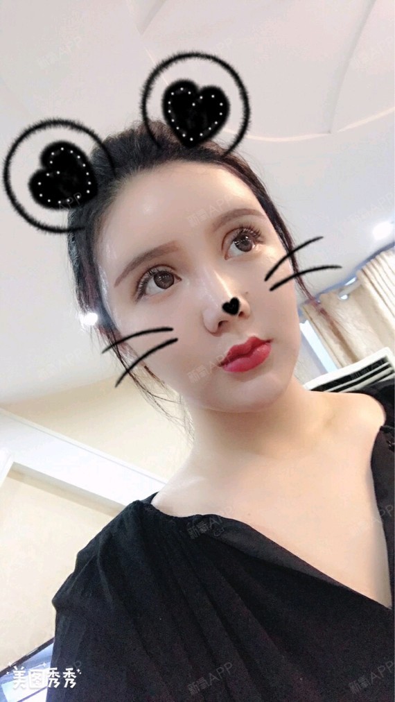 之心切开双眼皮第19天美丽日记-新氧美容整形