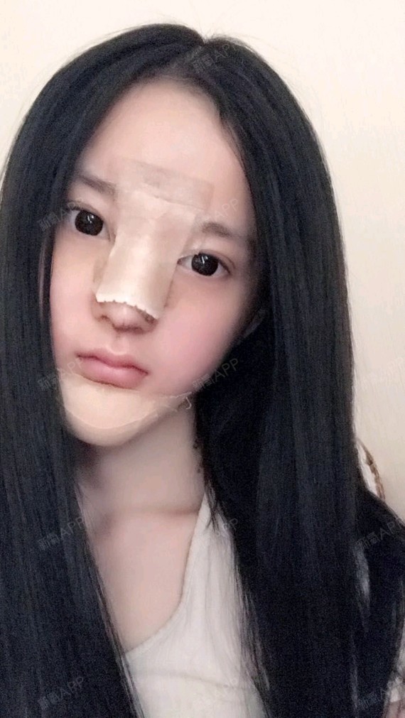 W欣怡鼻综合第4天美丽日记-新氧美容整形