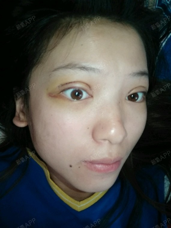 苏辰哒哒哒切开双眼皮第4天美丽日记-新氧美容