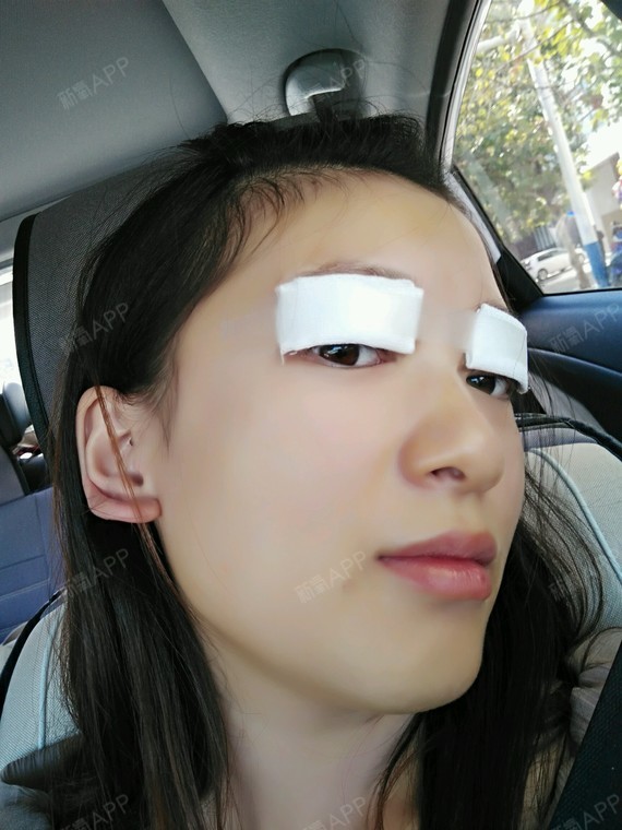 苏辰哒哒哒切开双眼皮第4天美丽日记-新氧美容