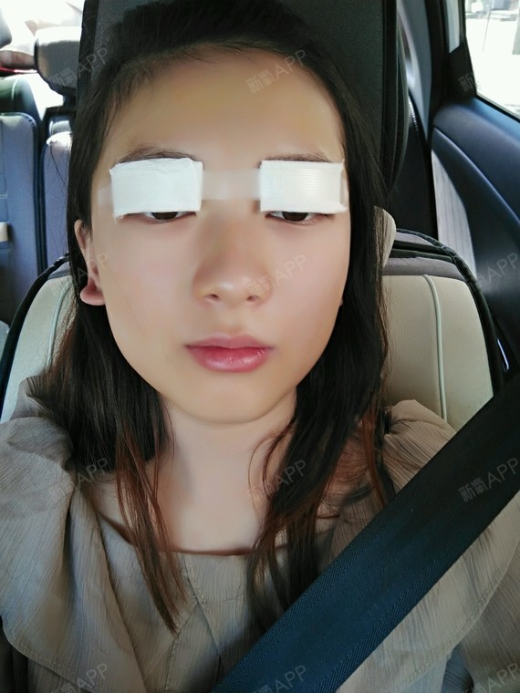 苏辰哒哒哒切开双眼皮第4天美丽日记-新氧美容