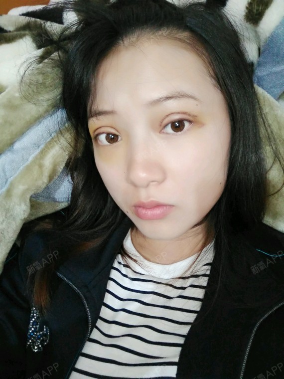 苏辰哒哒哒切开双眼皮第5天美丽日记-新氧美容