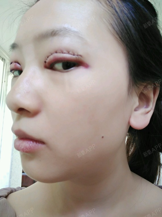 苏辰哒哒哒切开双眼皮第1天美丽日记-新氧美容