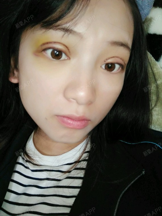 苏辰哒哒哒切开双眼皮第5天美丽日记-新氧美容