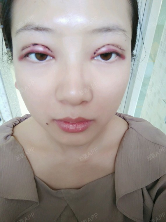 苏辰哒哒哒切开双眼皮第1天美丽日记-新氧美容