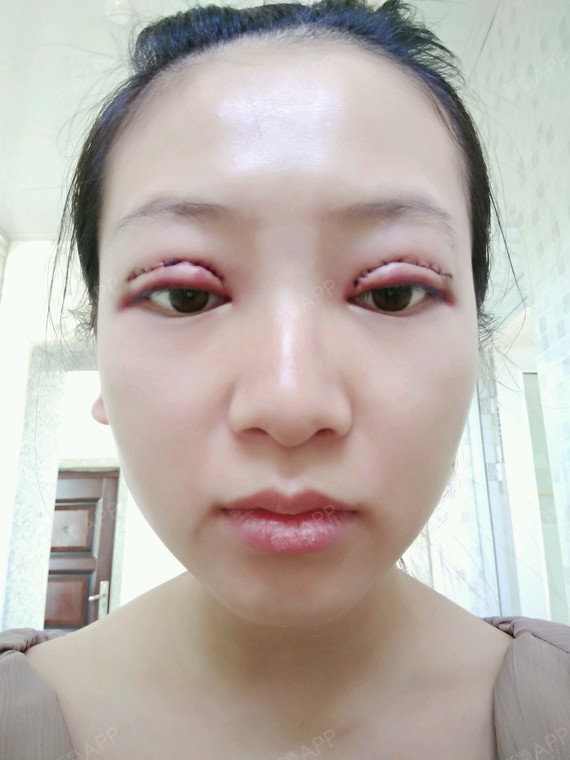 苏辰哒哒哒切开双眼皮第1天美丽日记-新氧美容