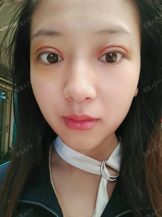 苏辰哒哒哒切开双眼皮第7天美丽日记-新氧美容