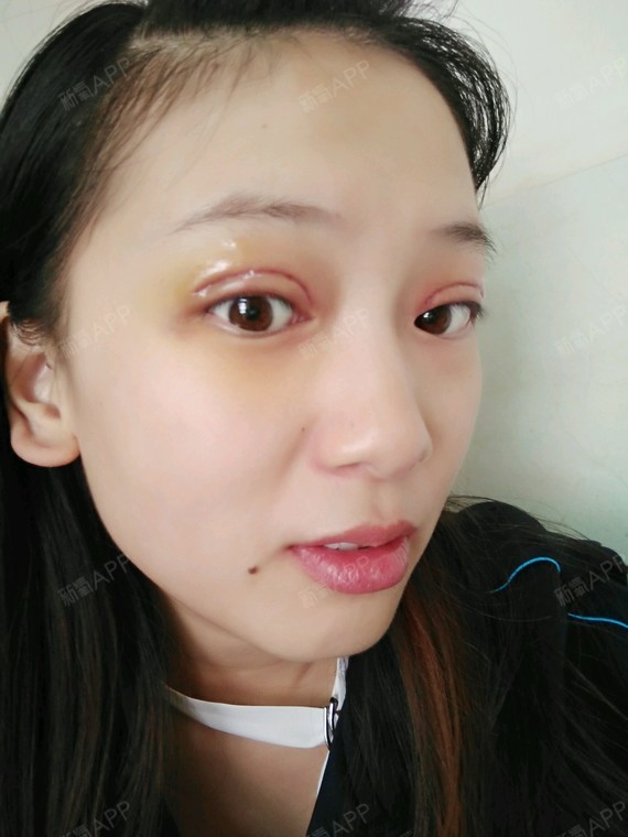 苏辰哒哒哒切开双眼皮第7天美丽日记-新氧美容