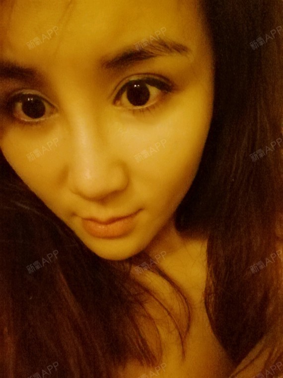 apple6677埋线提升第17天美丽日记-新氧美容