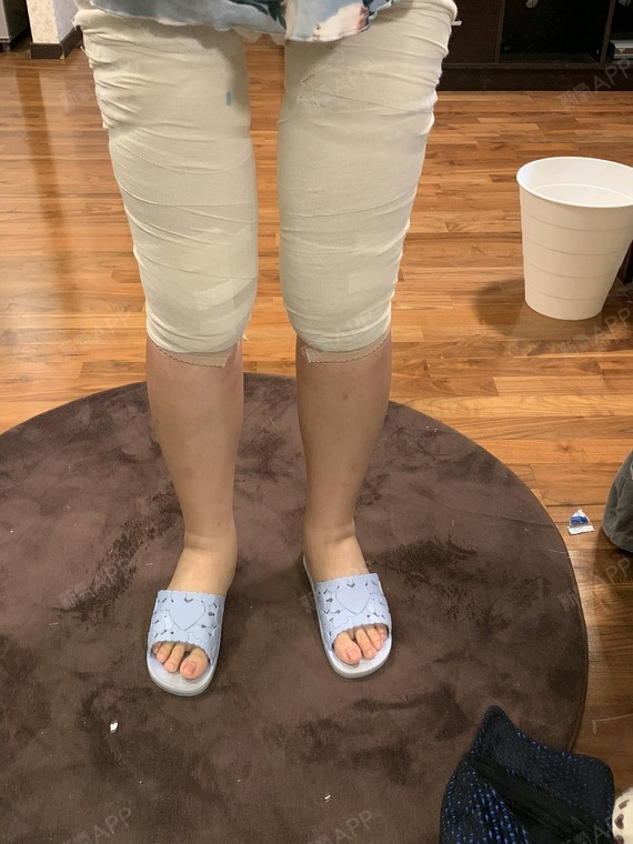 术后第2天