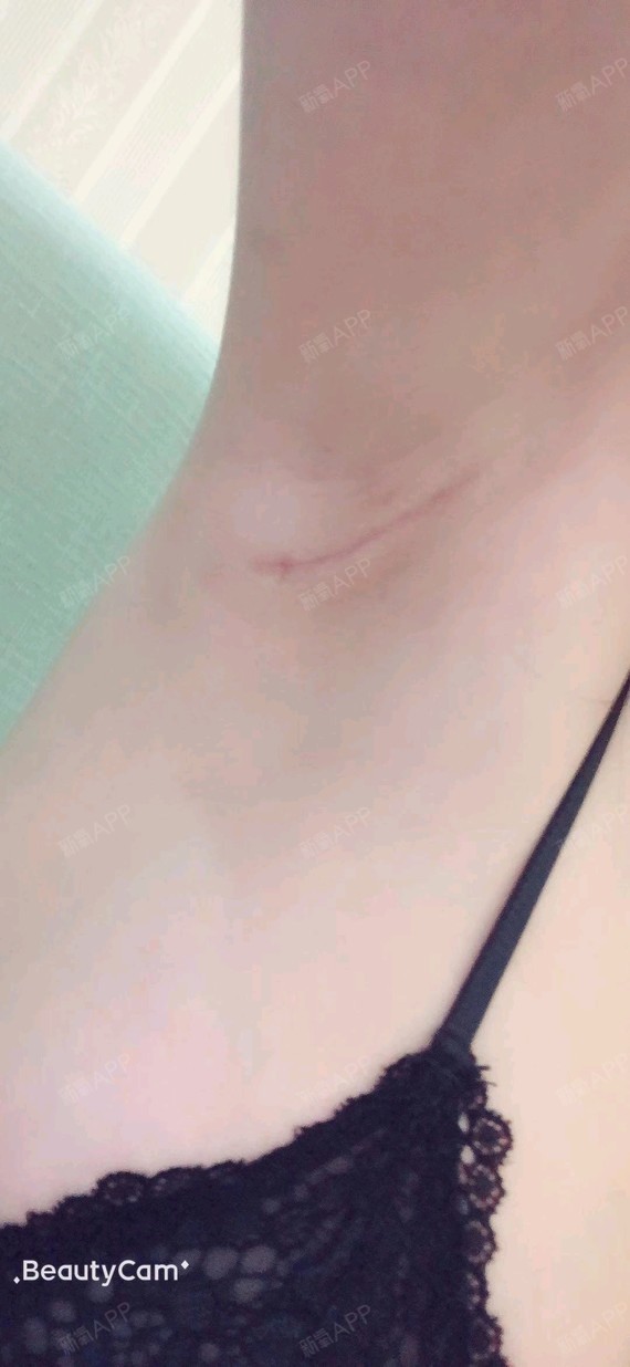 10号甜菜假体隆胸第36天美丽日记-新氧美容整