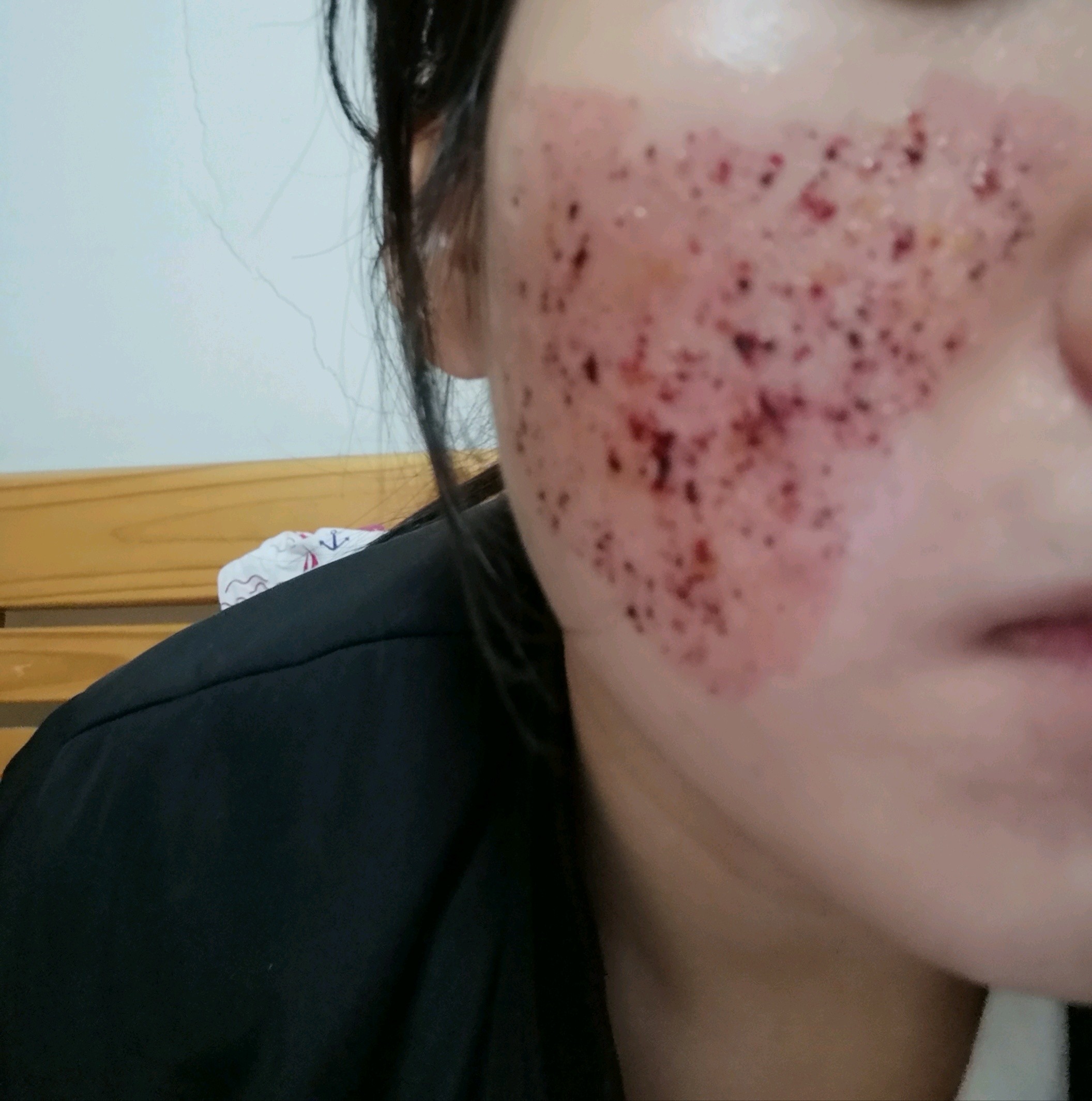 点阵激光第3天