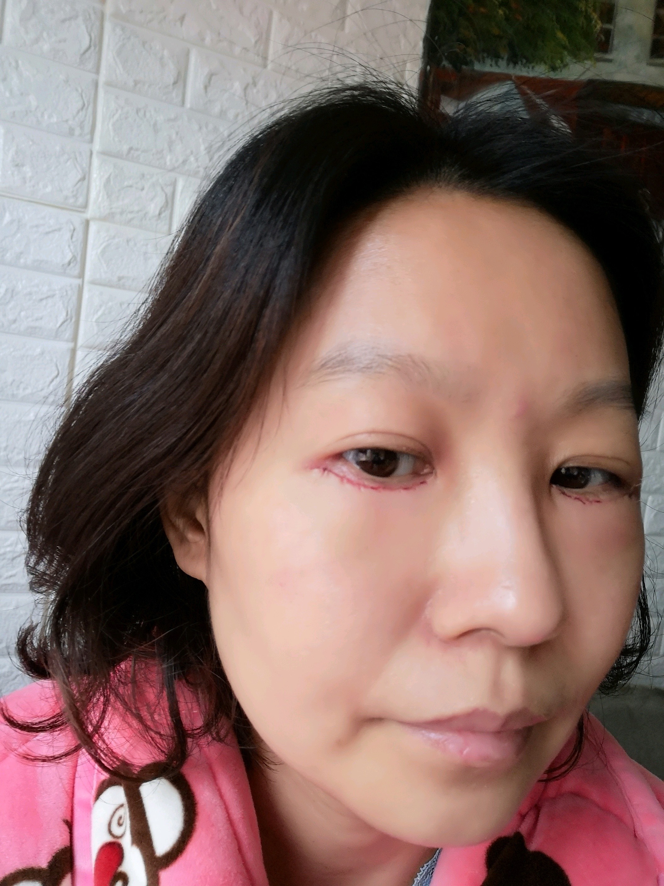 外切去眼袋第1天