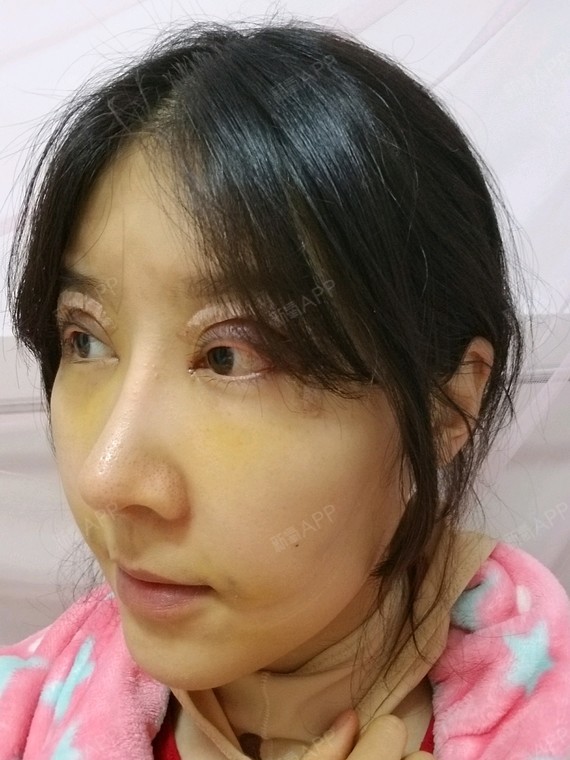 面部吸脂
