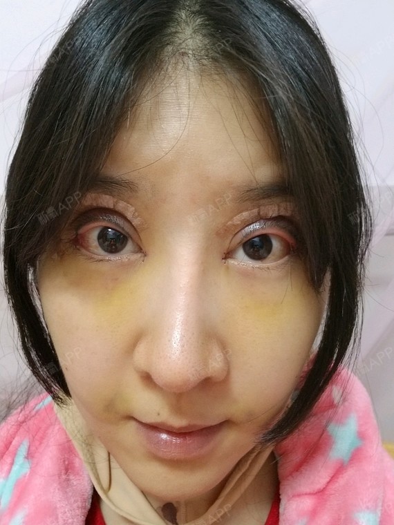 不知道是不是绷带太紧了,脸上都勒出了淤青,嘴角两边_圈子-新氧美容