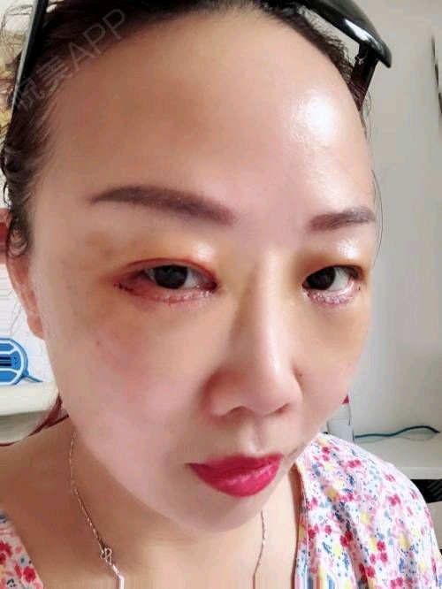 承德玥莱美医疗美容医院外切去眼袋怎么样_恢复过程