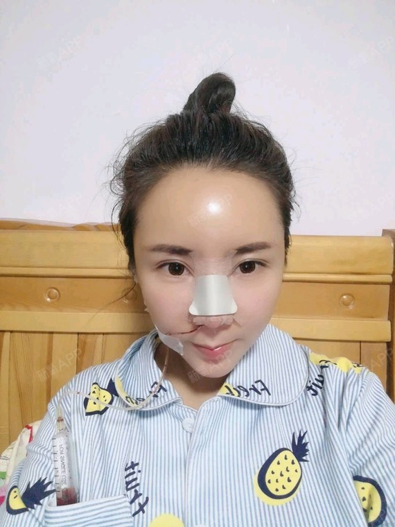 鼻骨矫正 | 驼峰鼻矫正 | 鼻部修复 | 天津同城 | 鼻小柱 | 手术