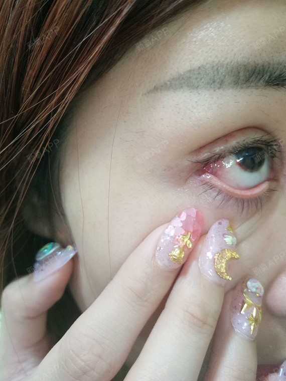 宝宝 你能帮我看看我的眼睛吗 第8天了 我眼角有个坑 是不是失败了