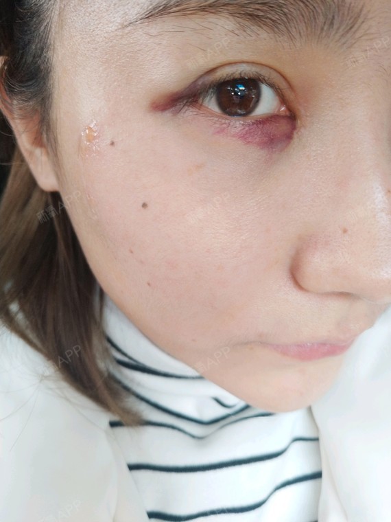 内切去眼袋