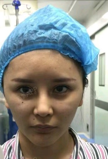 因无知打的童颜针,就是生长因子,有没有要去取生长因子,或者取过的