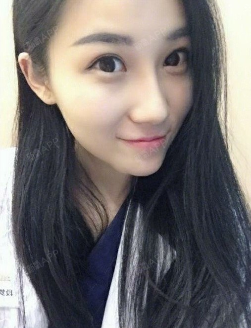 氧气0111611529937935硅胶隆鼻第35天美丽日记-新氧美容整形