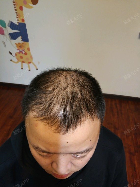 两个多月了,感觉头发长的比较慢,好希望快快长出来