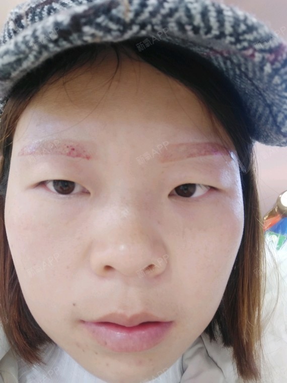 纹眉两年多一高一低忍受了两年多终于决定洗了,因为用过万能粉不知道