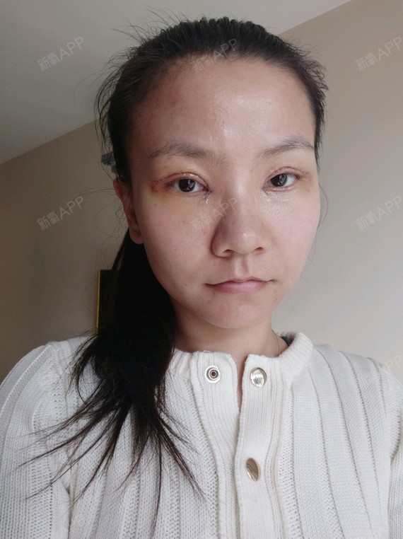 小马虎眼切开双眼皮第2天美丽日记-新氧美容整