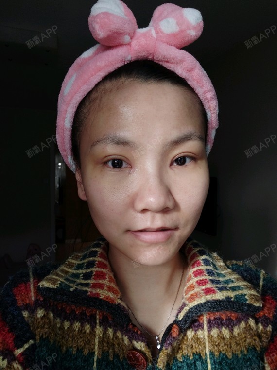 小马虎眼切开双眼皮第7天美丽日记-新氧美容整