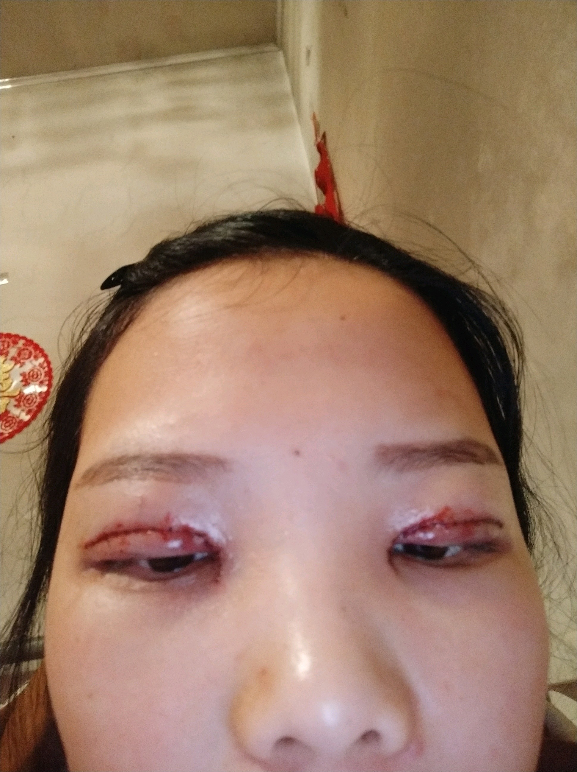 谁说切开双眼皮不疼的,涨得疼,做的过程中能听到剪刀剪自己的肉太恐怖