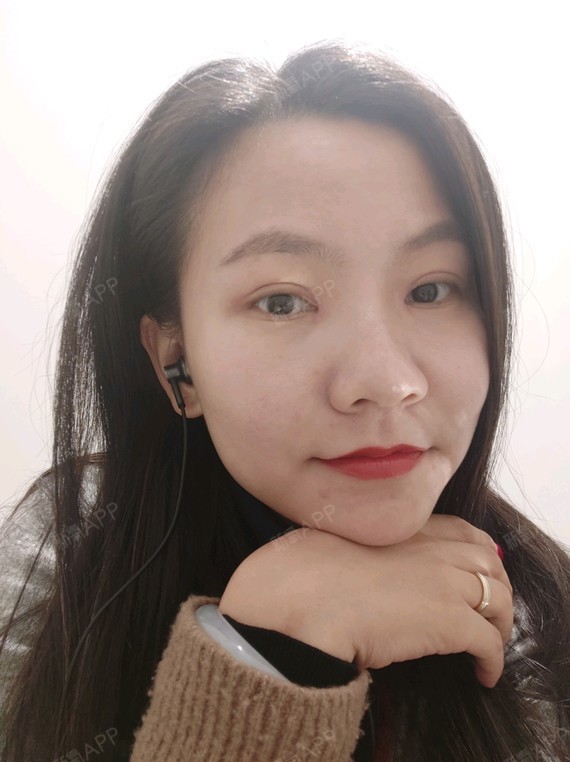 小马虎眼切开双眼皮第16天美丽日记-新氧美容