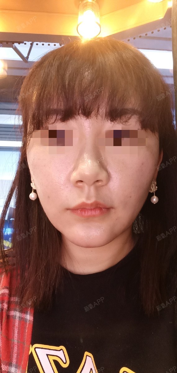 术后十天 下巴连脖子的地方有肿块了