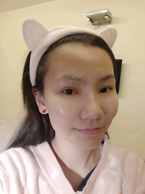 小马虎眼切开双眼皮第25天美丽日记-新氧美容