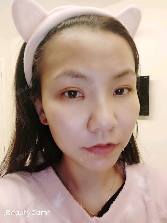 小马虎眼切开双眼皮第25天美丽日记-新氧美容