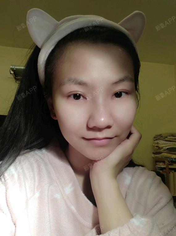 小马虎眼切开双眼皮第25天美丽日记-新氧美容