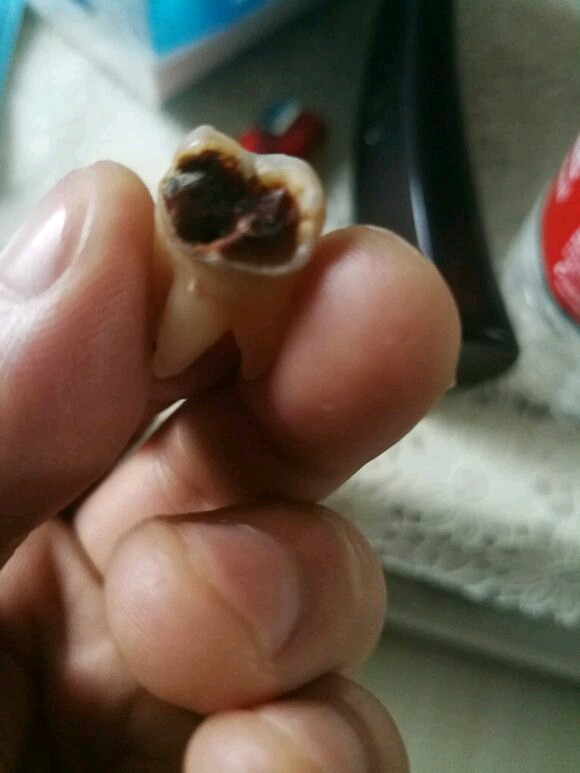 合肥靓美口腔医院拔牙怎么样_恢复过程_效果如何_笑成