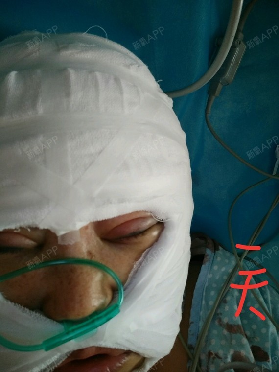 成都拉皮手术提升好不好_效果图_氧气zdez3拉皮手术术