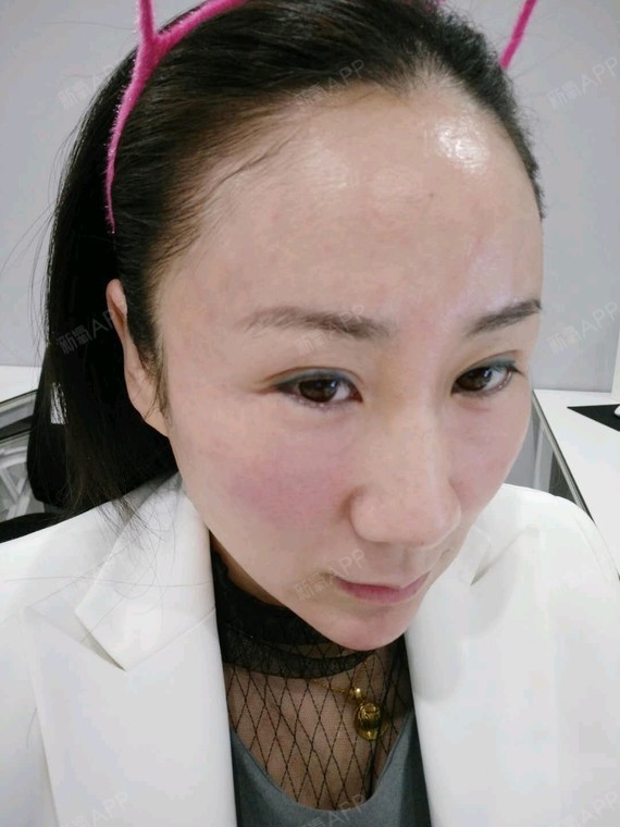 水光针