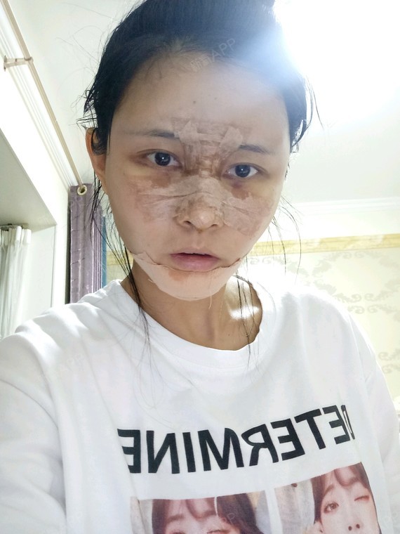 成都开内眼角好不好_效果图_氧气zla4s开内眼角术后第