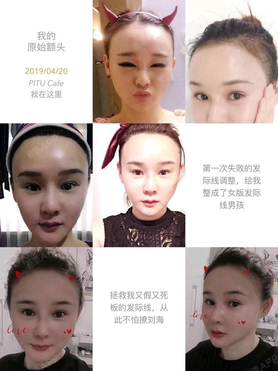 以前是先天性的大脑门,所以想通过发际线调整来缩小