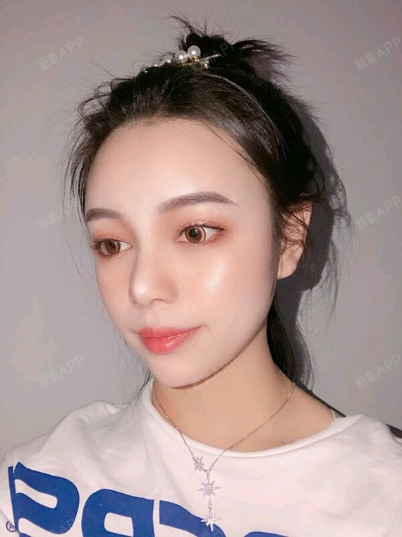 自体脂肪面部填充