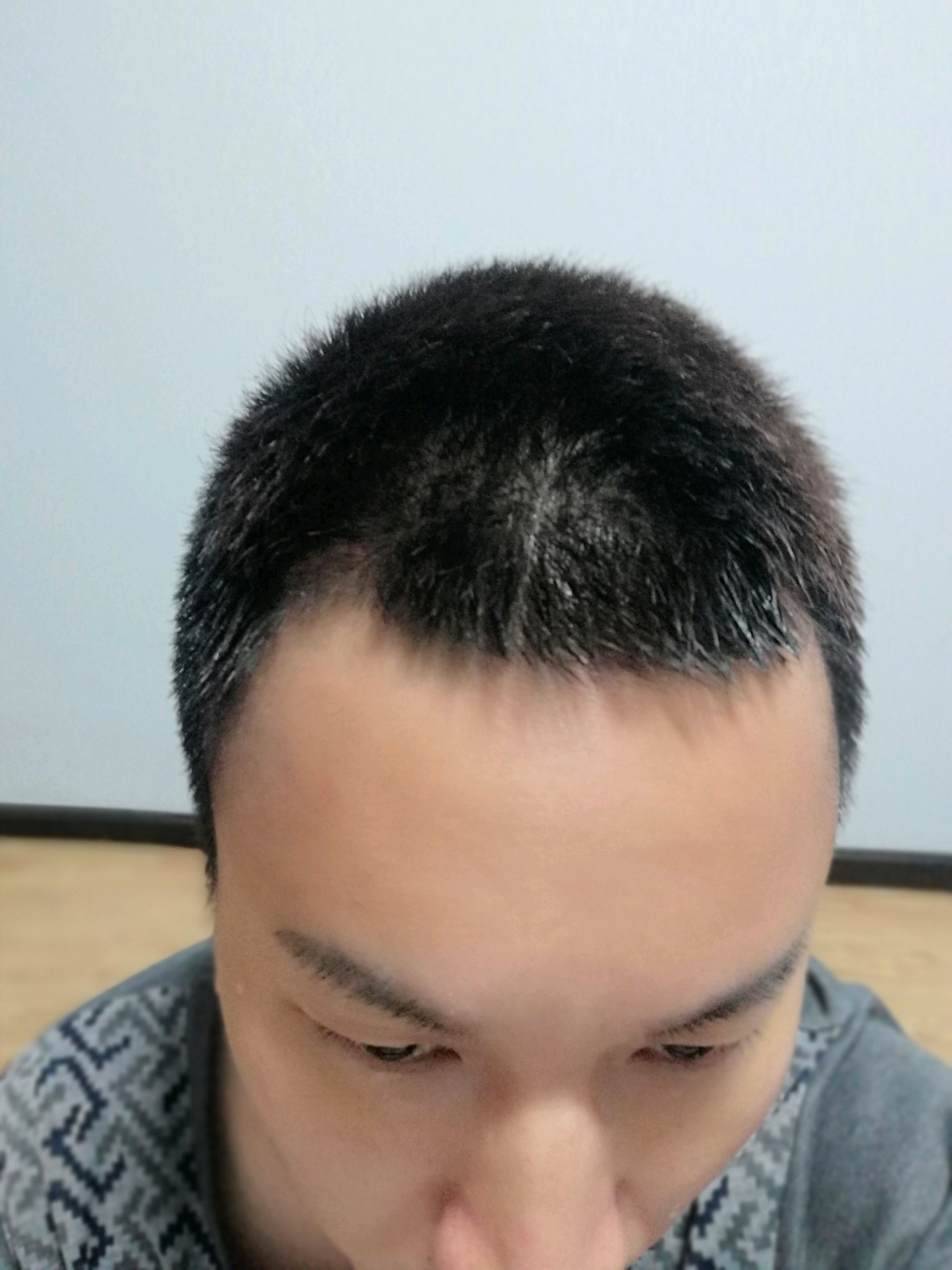 假体丰额头第15天